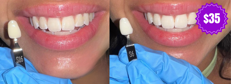 Teeth Whitening​ | Gigi's Beauty Bar | Tucson Arizona